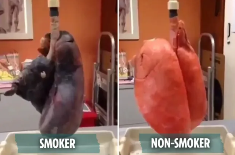 Experts reveal shocking difference between smoker's and non-smoker's lungs
